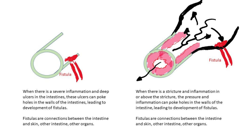 Diagram of a fistula.