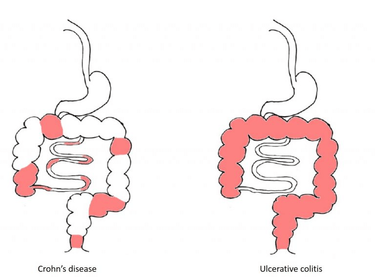 Ulcerative Colitis and Crohn's Disease: What's the Difference