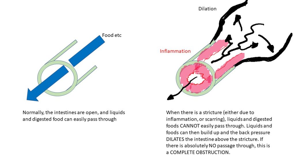 Diagram of a stricture.